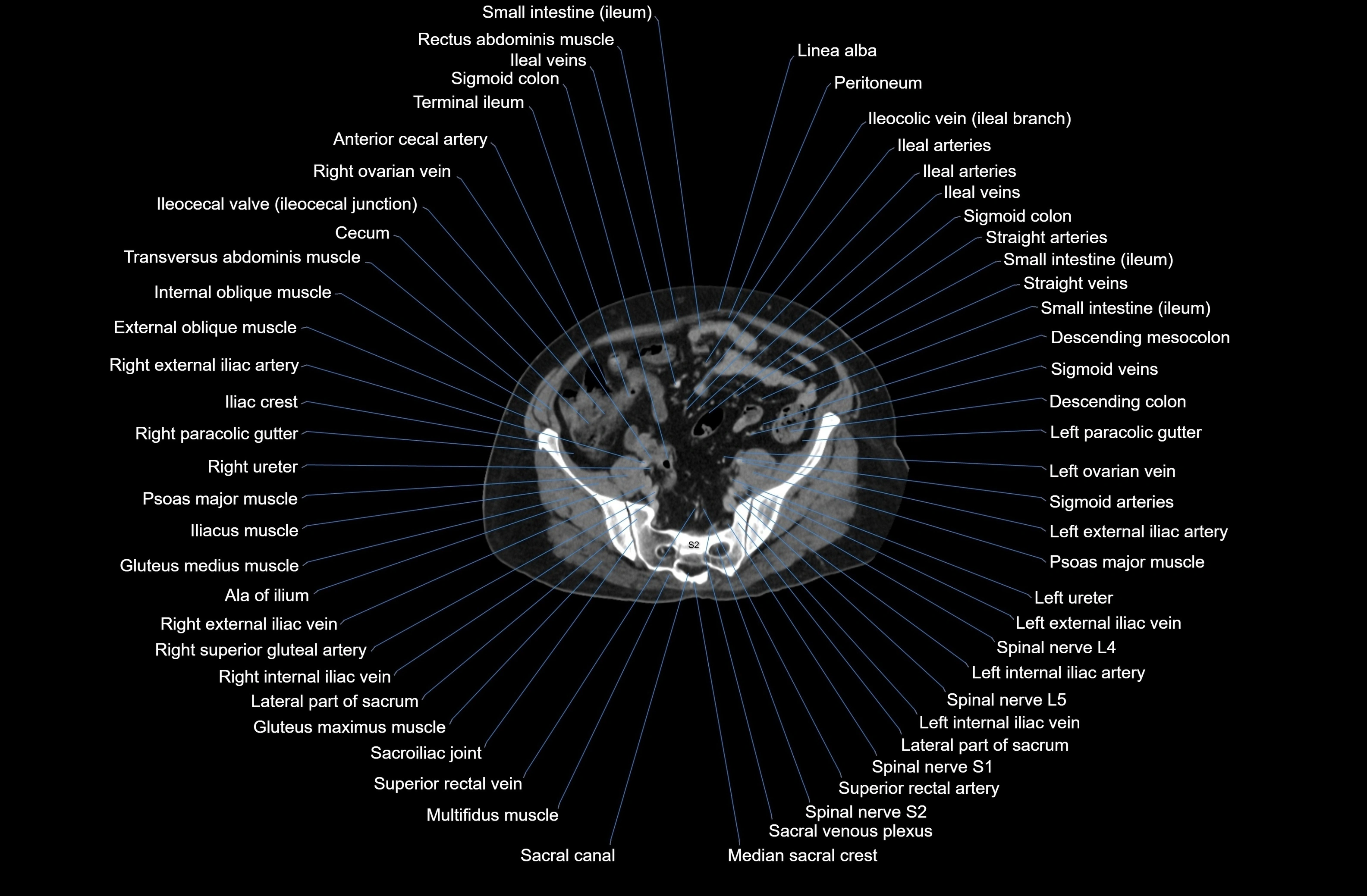 CT Abdomen axial cross sectional anatomy labelled radiology image-00071.webp